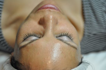 Chemical Peel before 607354