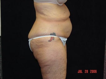 Body Lift with Liposuction of Abdomen, Waist, and Flanks before 203458
