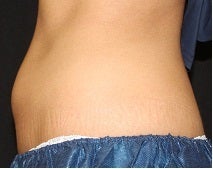 Coolsculpting-lower abdomen 445738