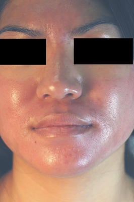 Photodynamic Therapy for Acne after 86366