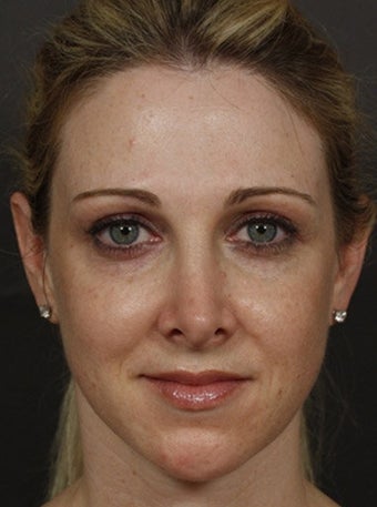 Sculptra after 324802