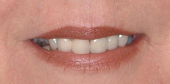 Smokers lines treated with Restylane and Botox in lips before 52827