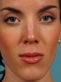 Revision Rhinoplasty before 581089