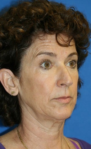 Facelift, Lateral Browlift, Fat Transfer, Chemical Peel 399966