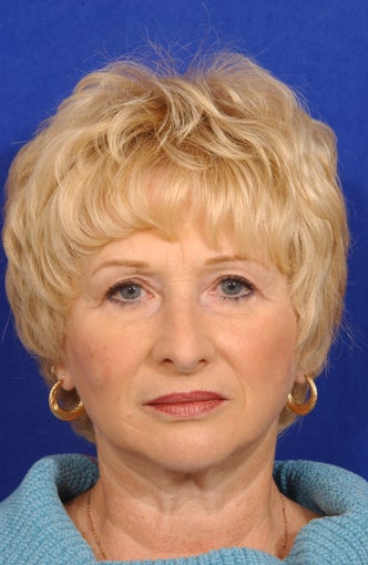 Face-necklift, Superficial cheeklift, upper blepharoplasty after 81614