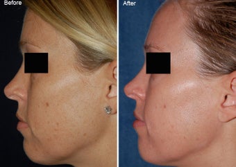 Fraxel Laser Resurfacing before 97893