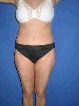 Tummy Tuck Surgery (abdominoplasty) after 143886