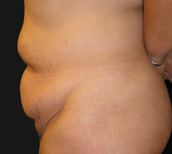 Abdominoplasty 458935