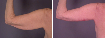 Arm Lift before 272281