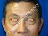 Eye Surgery (Blepharoplasty) before 617445