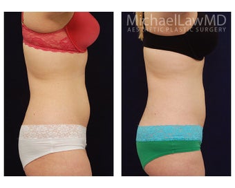 Liposuction 391813