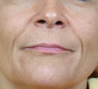 Radiesse treatment for nasolabial folds before 124912