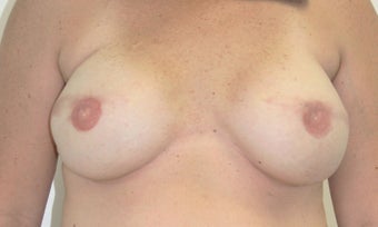 Breast Reconstruction after 517542