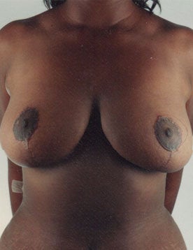 Breast Reduction after 375292