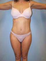 Tummy Tuck Surgery after 124891