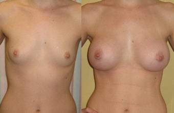 Brest Augmentation before 459524