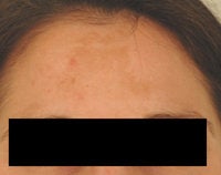 Melasma Treatment before 120086