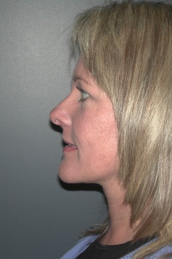 Facelift after 137858