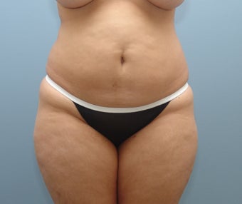 Liposuction to Full Abdomen and Full Back before 426734