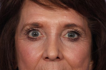 Eyelid Surgery after 324141