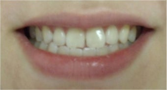 Zoom! Laser Whitening after 326051
