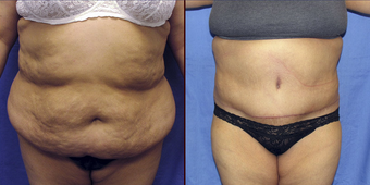 Tummy Tuck and Liposuction before 73799