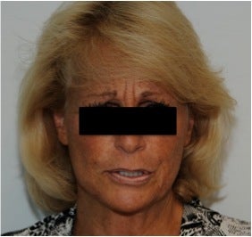 Evolence Injection in Glabella to Reduce Static Wrinkles before 123624