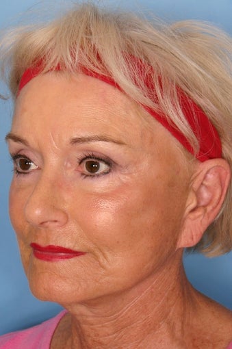 Sculptra Injections for Facial Volume Restoration after 112985