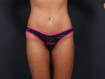 Tummy Tuck after 462576