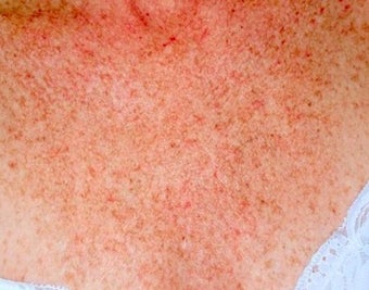 IPL Treatment for Chest before 374398