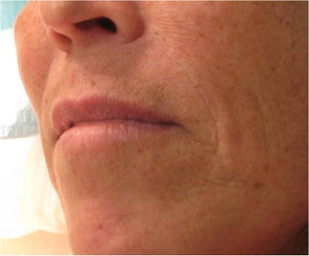 Juvederm to Upper Lip before 77462
