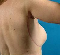 Arm Lift and Upper Body Lift after 138841