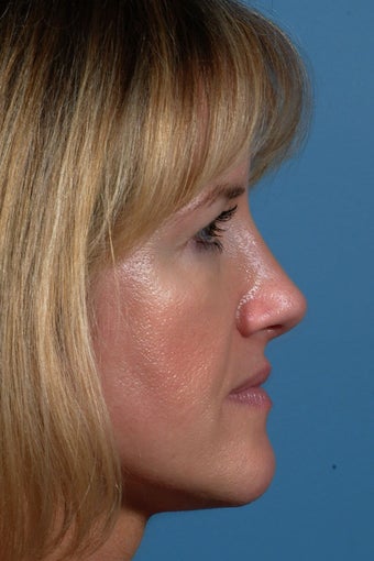 Rhinoplasty after 87108