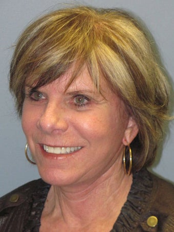 Neck Lift, Platysmaplasty 634723