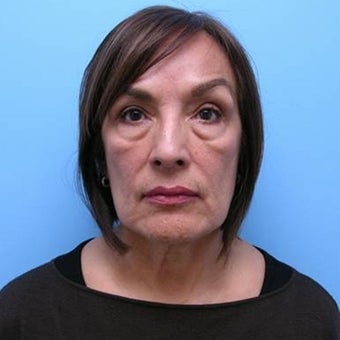 Face and Neck Lift with Bilateral Lower Eyelid Skin Excision and an Autologous Fat Transfer to the Face before 551915