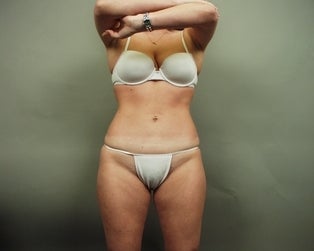 Liposuction after 304419