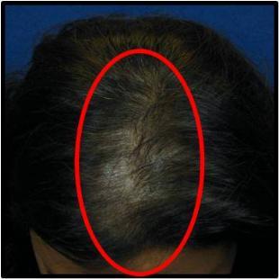 Female Hair Restoration 530044