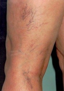 Sclerotherapy before 370422