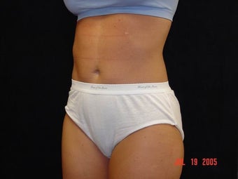 Liposuction of Abdomen, Waist, Flanks, Outer Thighs, with 6 Pack Abdominal Etching before 203555