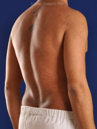 Vaser Hi Def Liposuction of the abdomen, chest, back, and flanks with fat injections to the pectoralis region 422700