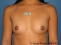 Breast Augmentation before 147529