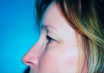 Eyelid Surgery (Blepharoplasty) before 265351