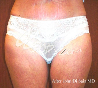 Inner Thigh Lift after 84026