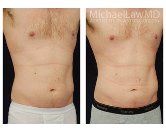 Liposuction after 392463