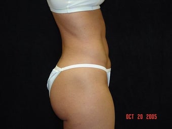 Liposuction of Abdomen, Waist, Flanks, Outer Thighs with 6 Pack Abdominal Etching after 203552