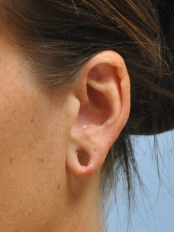 Ear Lobe Repair before 602967