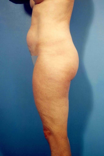 Abdominoplasty before 356390