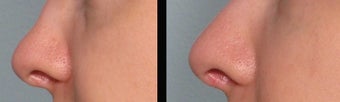 Juvederm before 460603