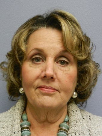 Neck Lift 598886