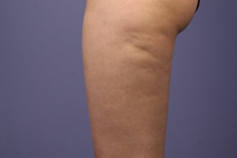 Cellulaze before 576600